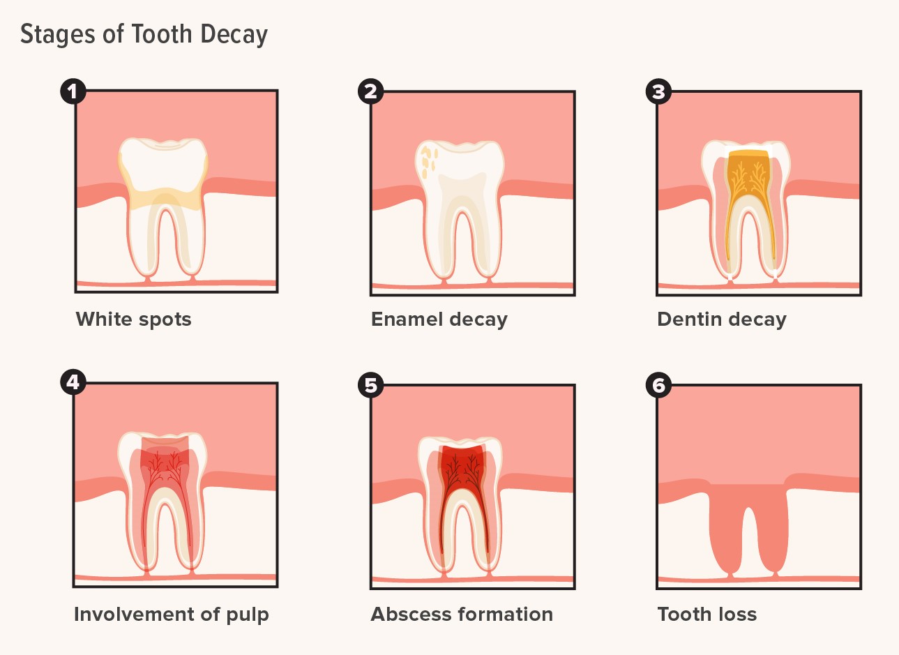 479714-The-Stages-of-Tooth-Decay-What-They-Look-Like_1296x1172-body.jpg