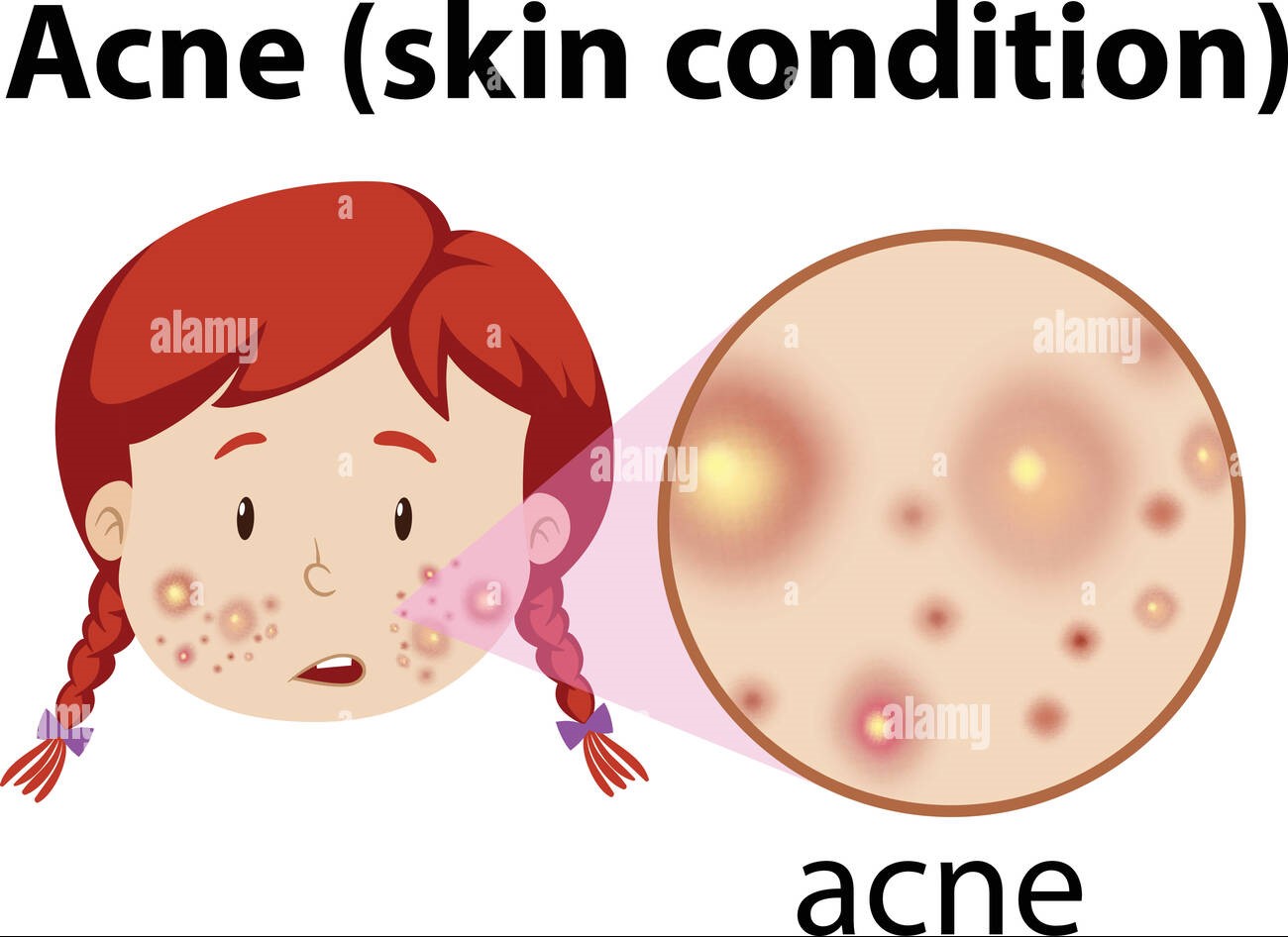 a-young-girl-having-acne-2GRX3JY.jpg