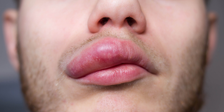 aha-angioedema-en.jpg