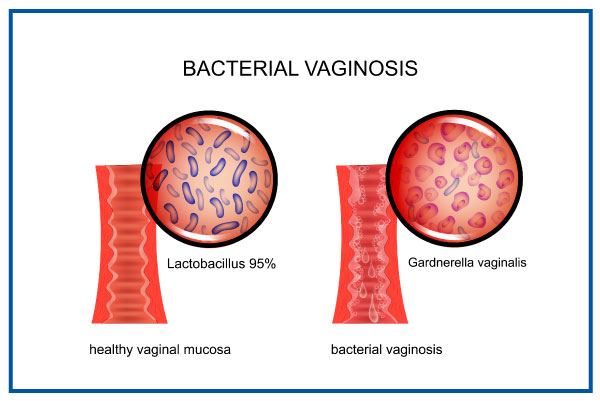 bacterial-vaginosis-overview.jpg