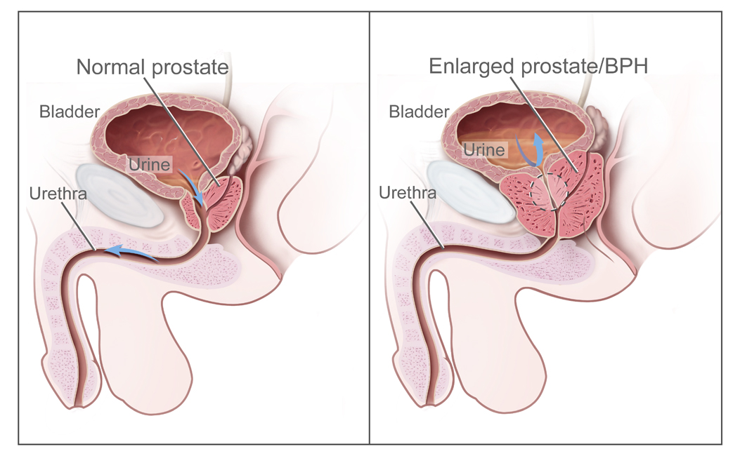 Benign_Prostatic_Hyperplasia_nci-vol-7137-300.jpg