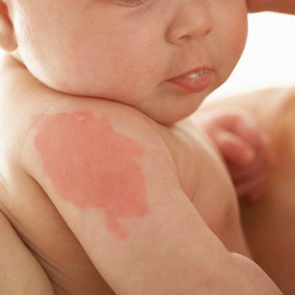 birthmarks-in-newborns-causes-and_2.jpg