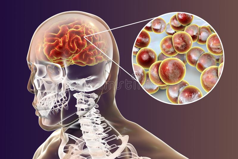 brain-infection-neisseria-meningitidis-bacteria-d-illustration-gram-negative-diplococci-cause-...jpg