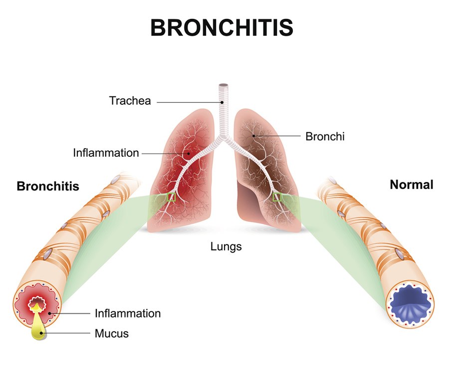 bronchitis-lg.jpg