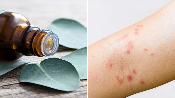 can-essential-oils-help-eczema-722x406.jpg