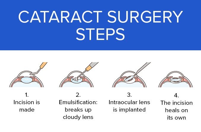 catarct-surgery-steps-678x446.jpg