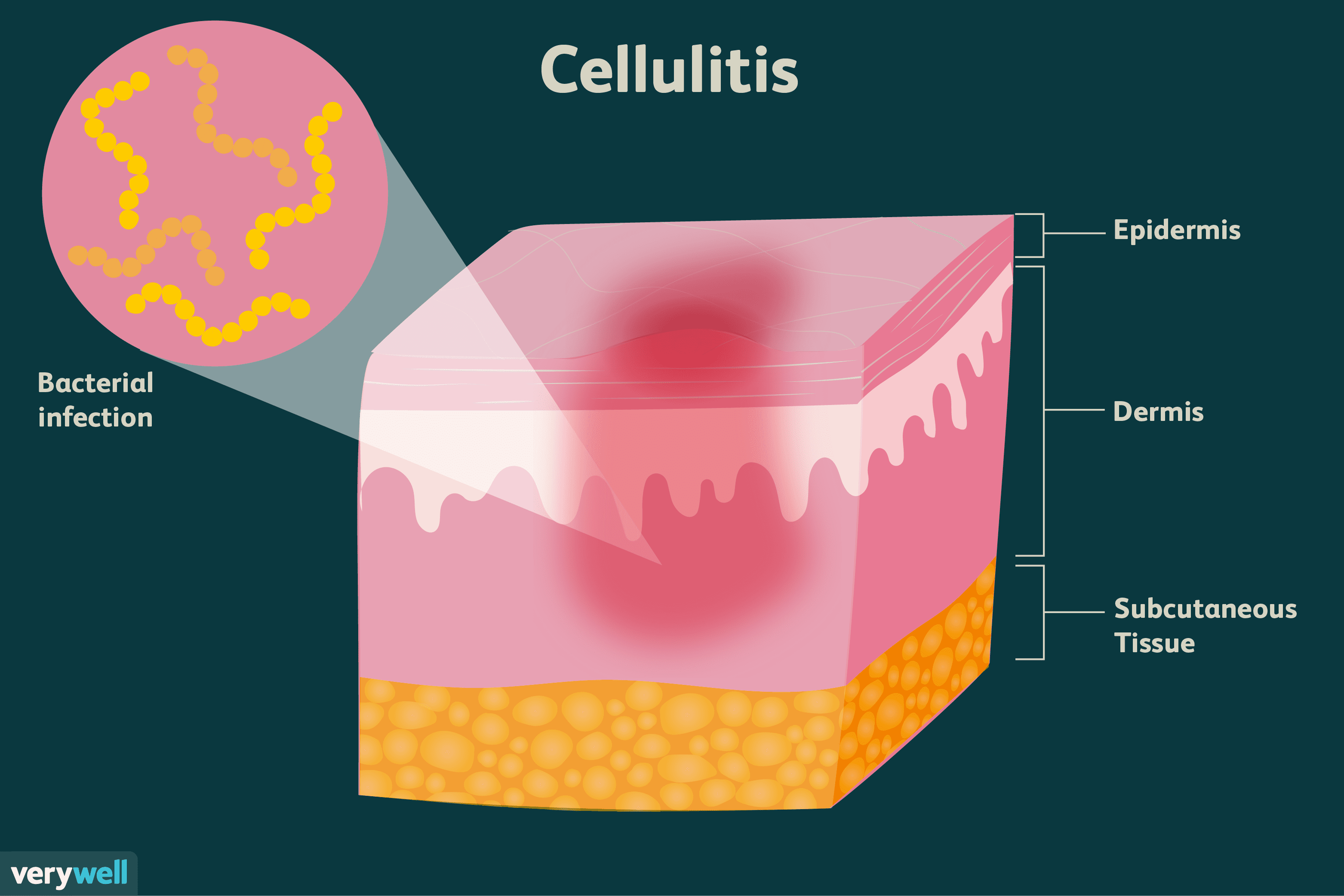 cellulitis-information-1069431_v2-01-a2b55d9816ae4204bba2f13eff629133.png