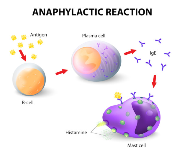 Charleston-Allergy-Asthma-anaphylactic-reaction-300x262@2x.jpg