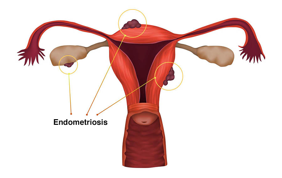 endometriosis-illustration-fcc644.jpg