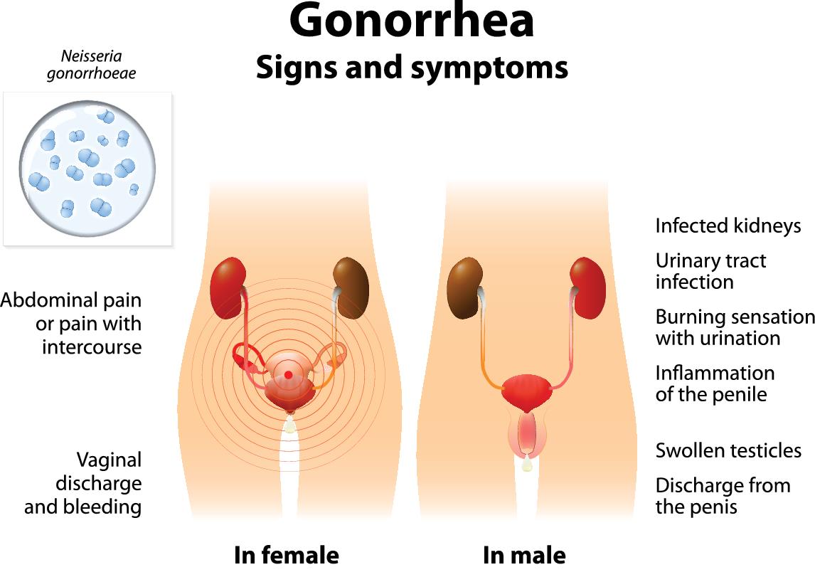 gonorrhea_diagram.jpg