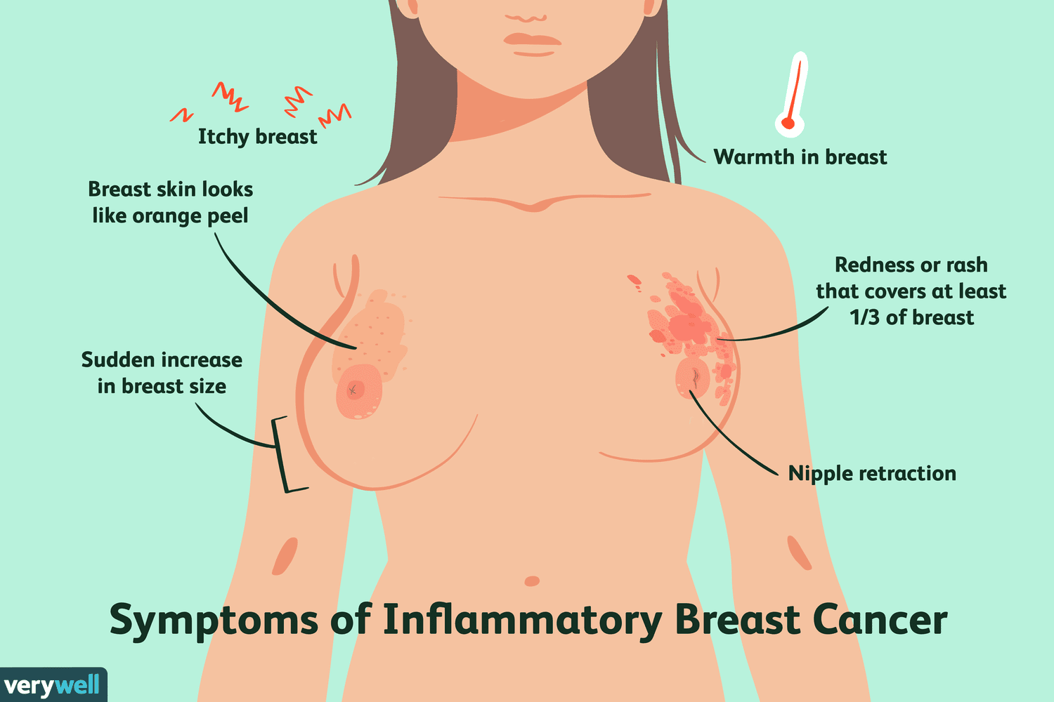 ibc-inflammatory-breast-cancer-430621_v2-1709b25eae064bb490204f3070d423a1.png