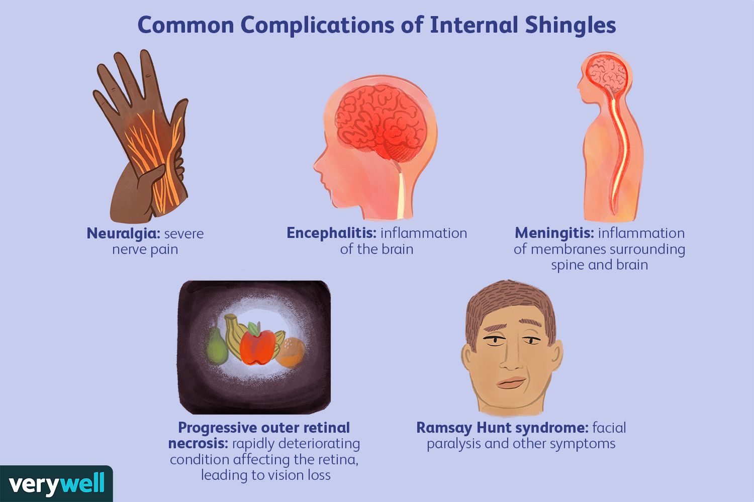 internal-shingles-risks-and-complications-5180098-FINAL-1bb25788aa7042c78689986b69df5f96.jpg