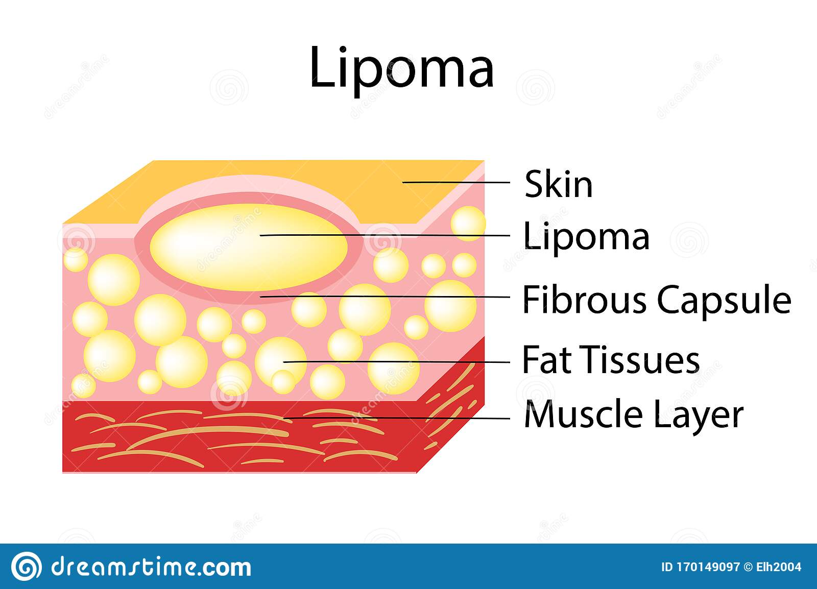 lipoma-adipose-tumors-located-subcutaneous-tissues-vector-illustration-170149097.jpg