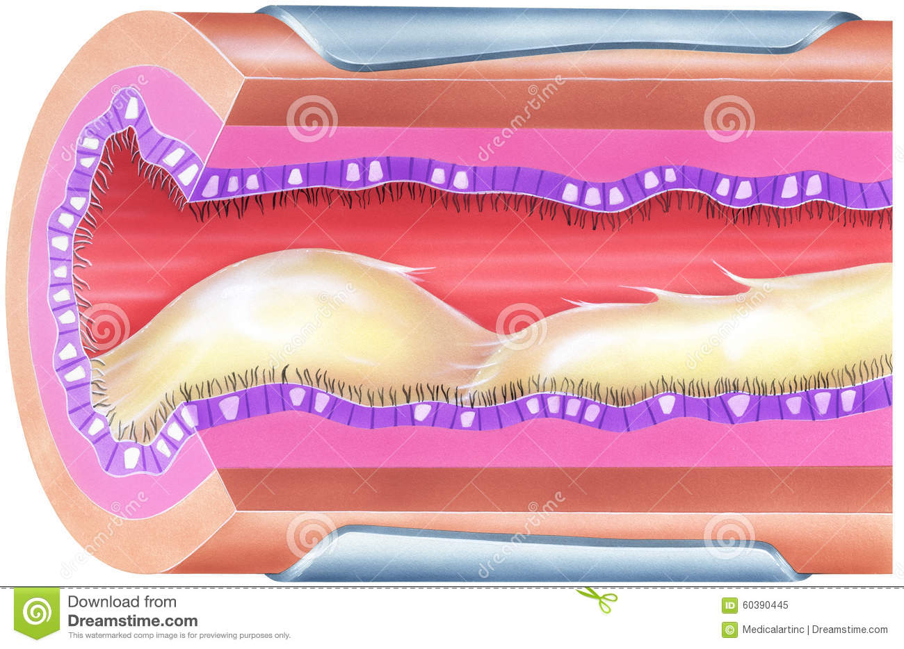 lungs-bronchial-mucus-causing-airway-obstruction-narrowing-shown-due-to-viscid-excessive-airwa...jpg