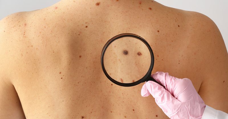 melanoma_skin-cancer-magnifying-glass.jpg