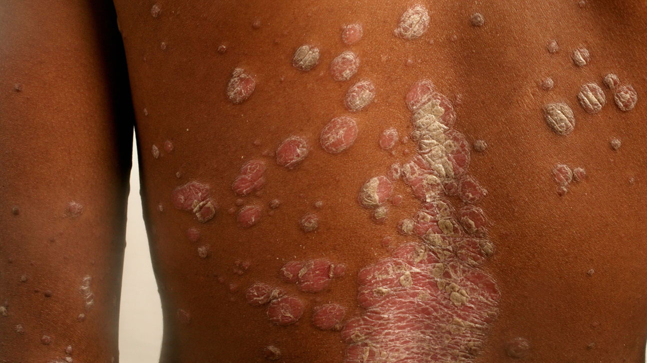 Psoriasis-on-trunk-1296x728-gallery_slide4.jpg