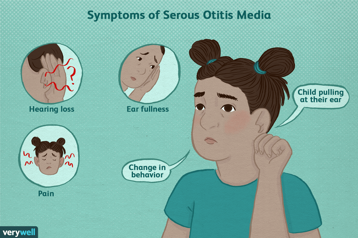 serous-otitis-media-1192122-5c896a86c9e77c000142303e.png