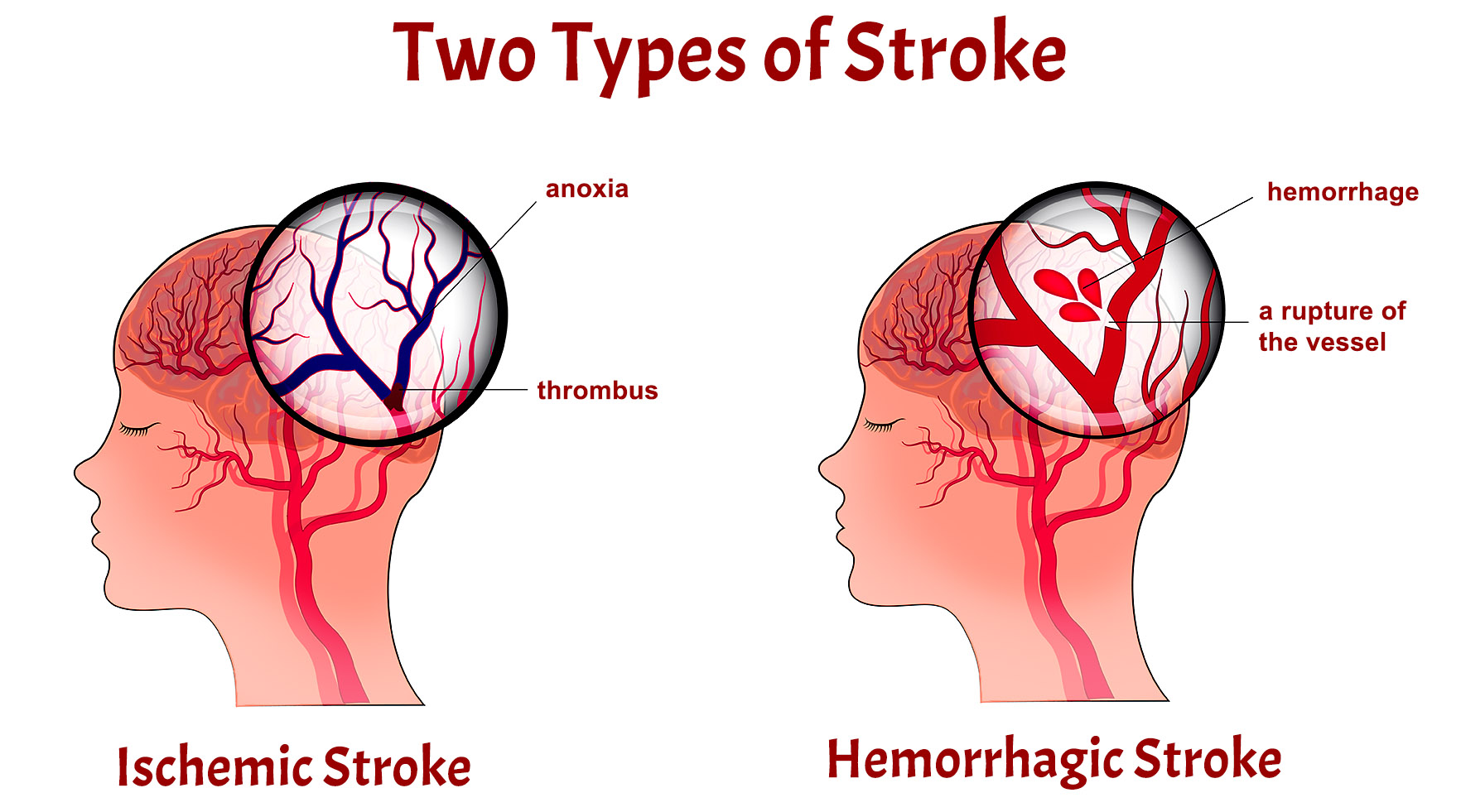 stroke-1.jpg