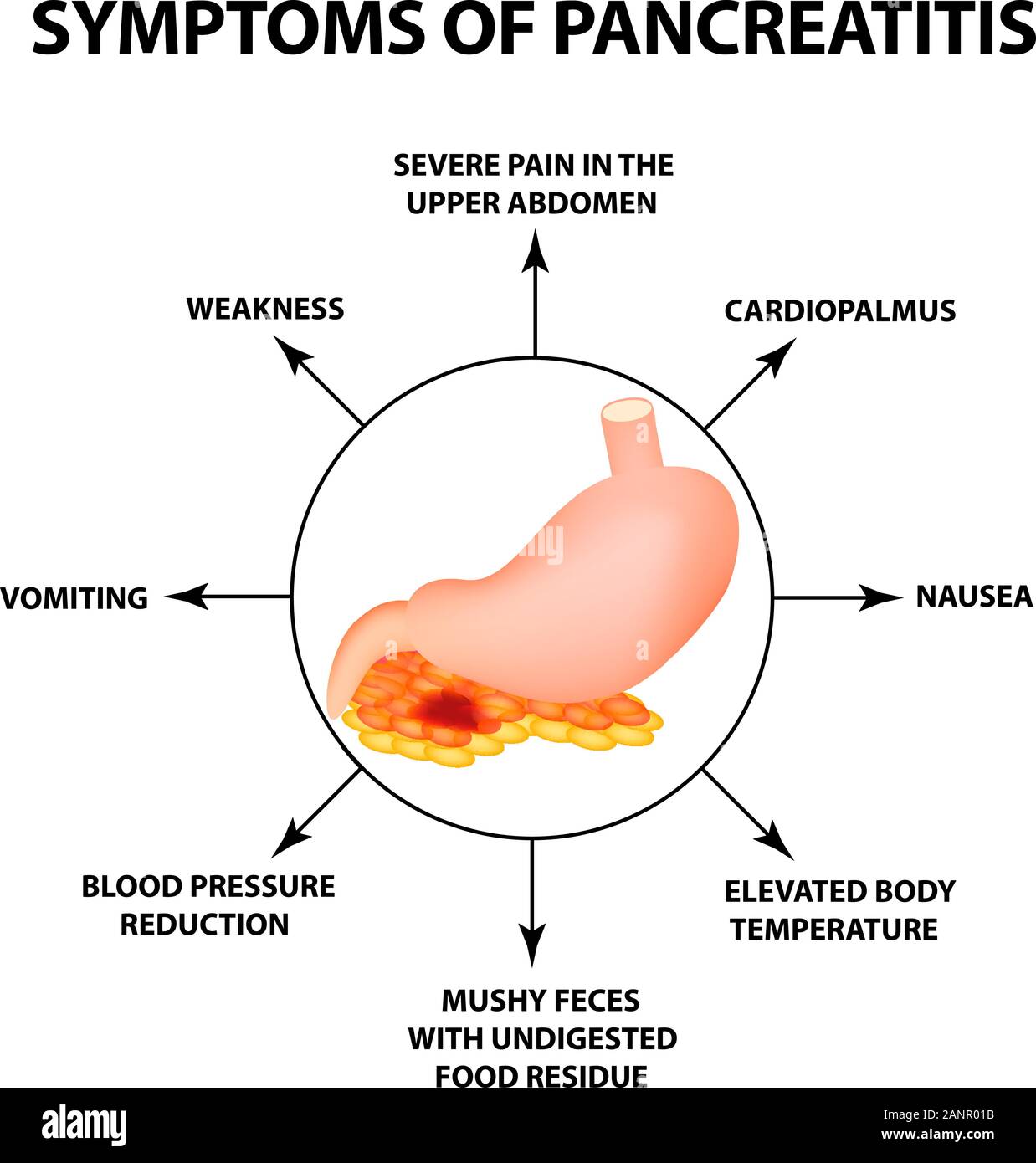 symptoms-of-pancreatitis-the-structure-of-the-stomach-and-pancreas-infographics-vector-illustr...jpg