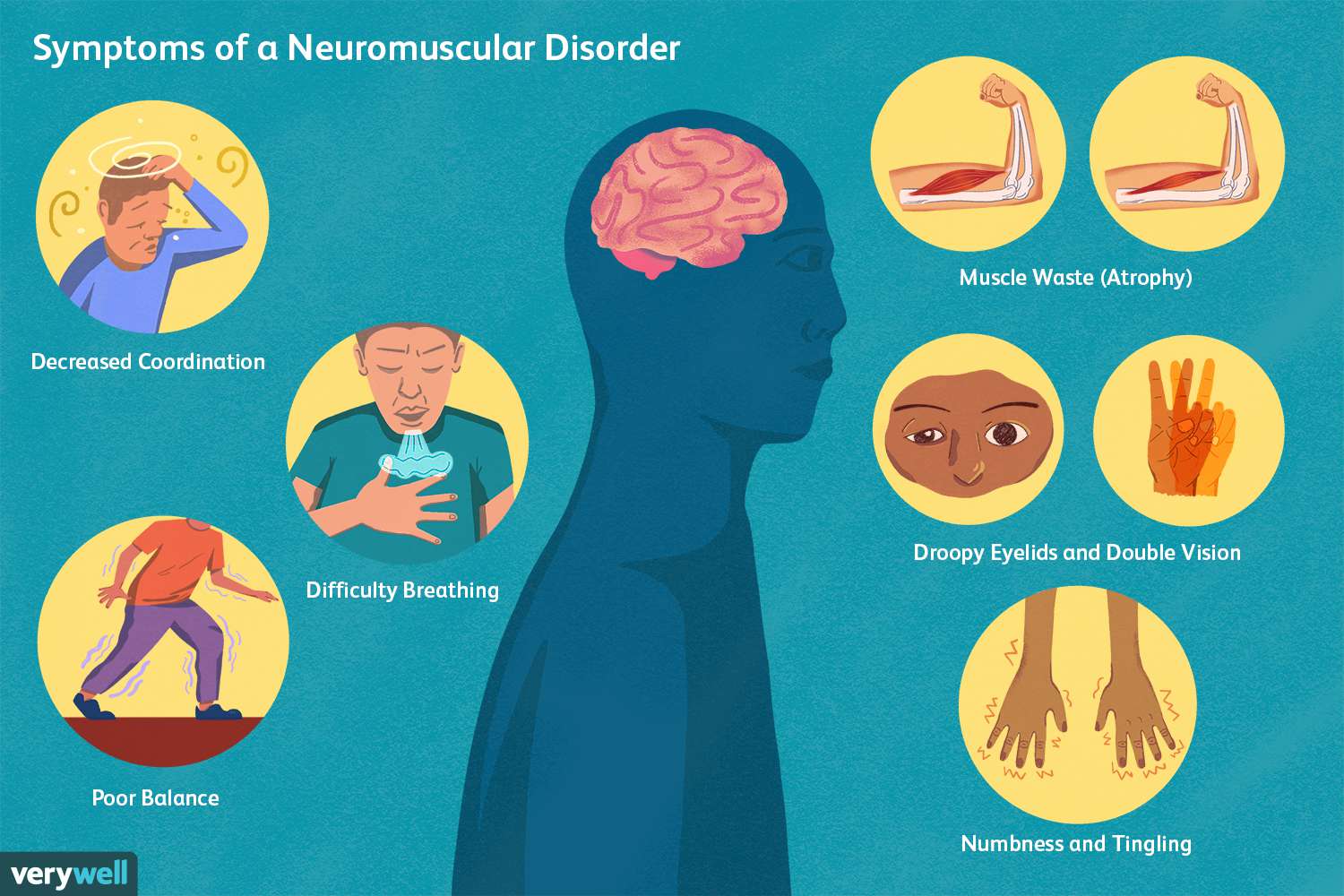 SymptomsofaNeuromusculardisorder_5180051_Color-2623d1c3141d49cba5d4fd93e43fe95c.jpg