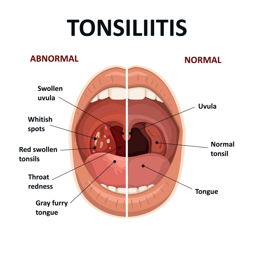 Tonsillitis-1024x1024.jpg