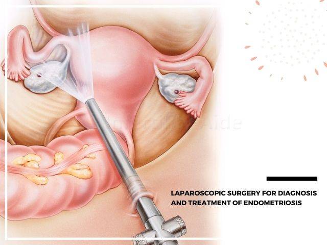 Treatment-diagnosis-of-endometriosis.jpg