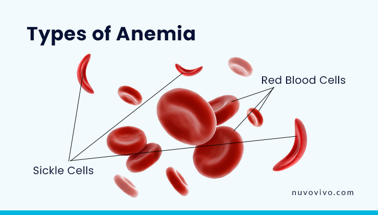 Types-of-Anemia.jpg