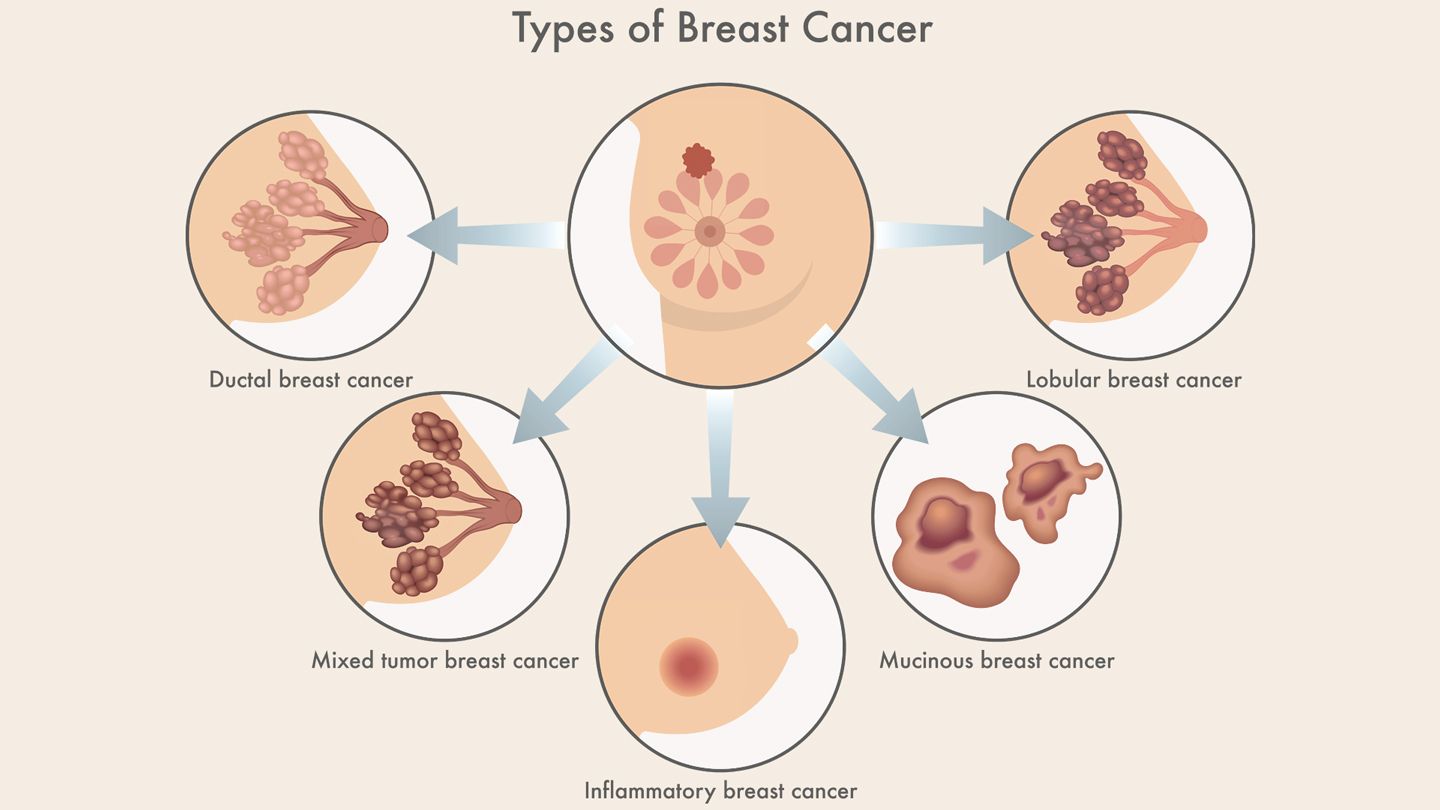 types-of-breast-cancer-guide-1440x810.jpg