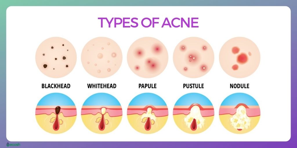 Types_of_Acne.jpg