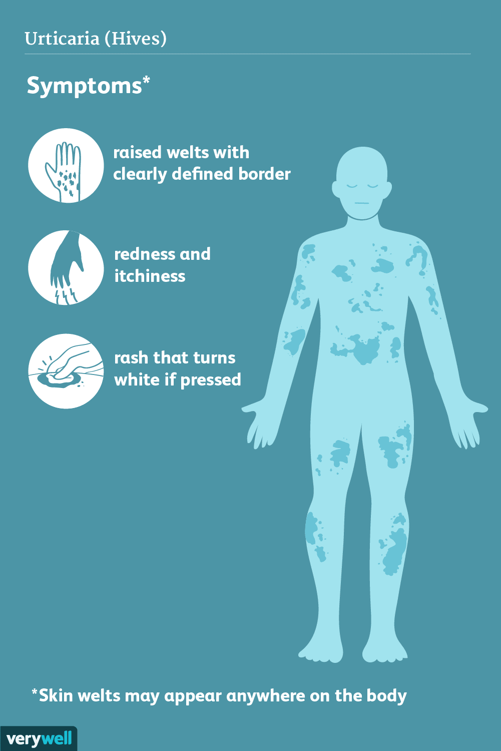 urticaria-symptoms-5b55f74746e0fb0037d9ef2a.png