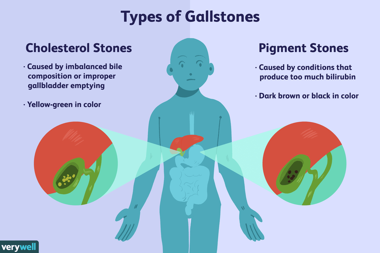 what-are-gallstones-1742784_final-1d48008cf7b74dcc88789e38623b1883.png