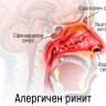 Алергичен ринит - симптоми, лечение, лекарства.Сенна хрема