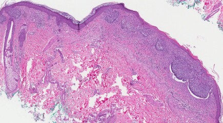 Articles - Sarcoma - Symptoms, Treatment, and Prevention
