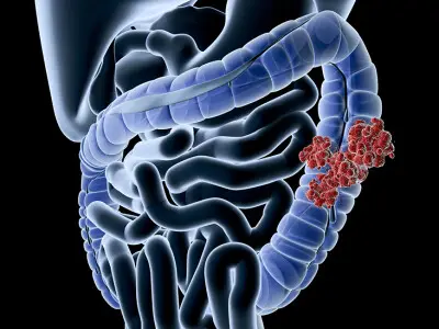 Articole - Cancerul de colon - simptome, stadii, tratament și prevenire