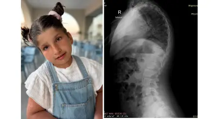 Natalie’s curved spine is making it difficult for her to breathe